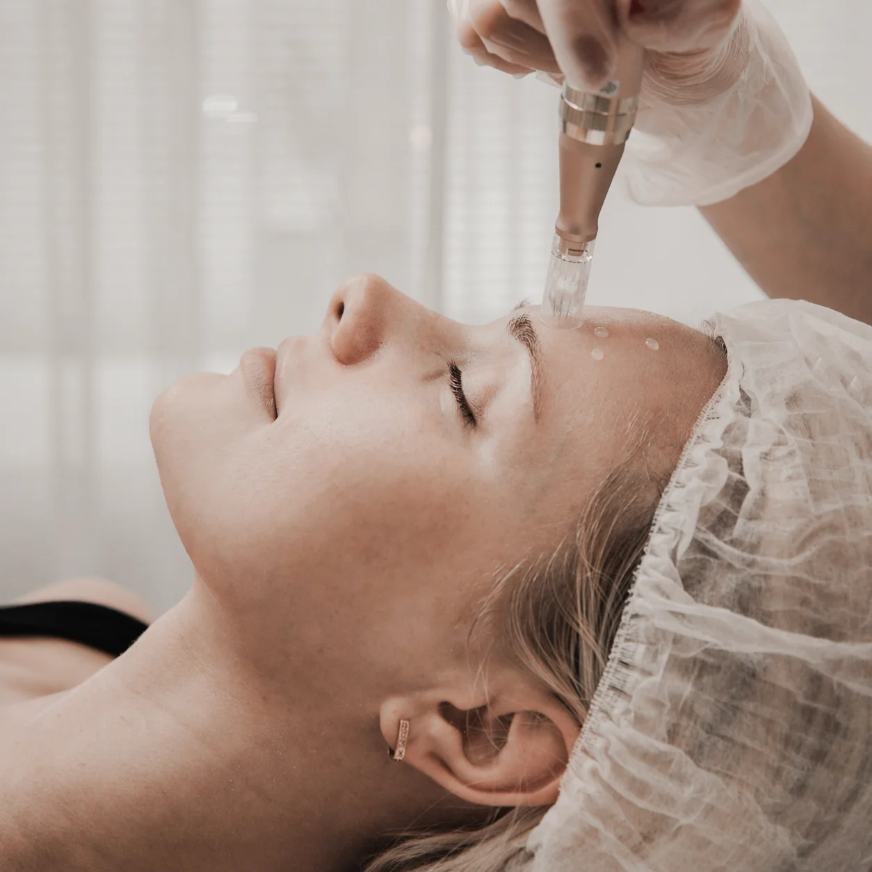 Mezoterapija BeautyRigaAtelier Dermapen Skaistumkopšana